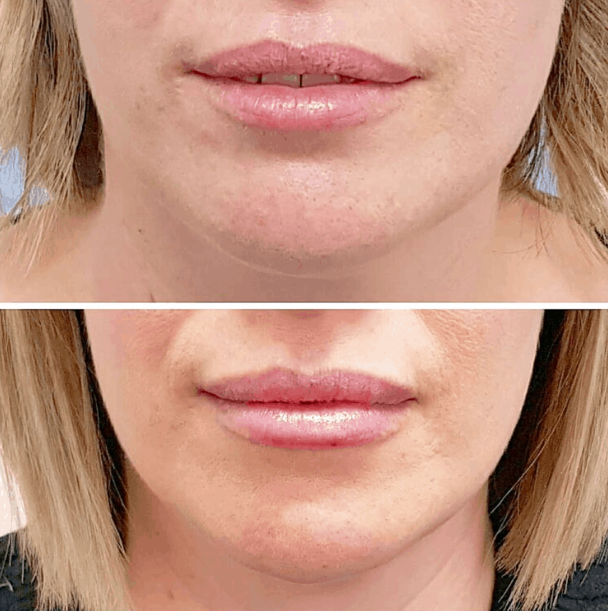 Guide to lip dermal fillers: What to expect - Envieskin Canberra