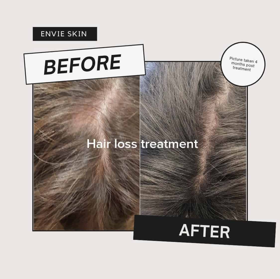 Hair loss before and after