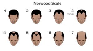 Norwood scale