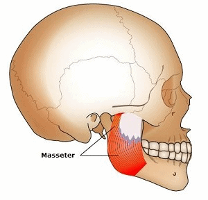 how to treat teeth clenching deforminities through masseter injections